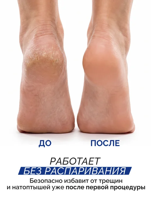 Victoria's Professional Кератолитик-лезвие средство жидкое для пяток 2 шт, 2 шт, фото 2