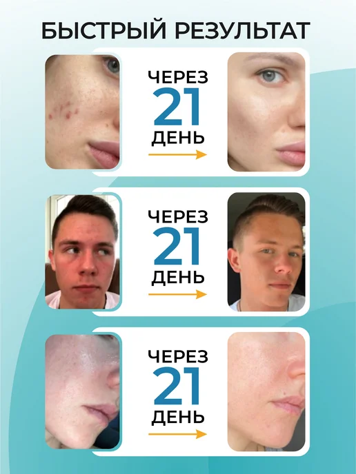 БьютиЦевтика Набор Акневицид без спирта от прыщей и несовершенств, белый, фото 6